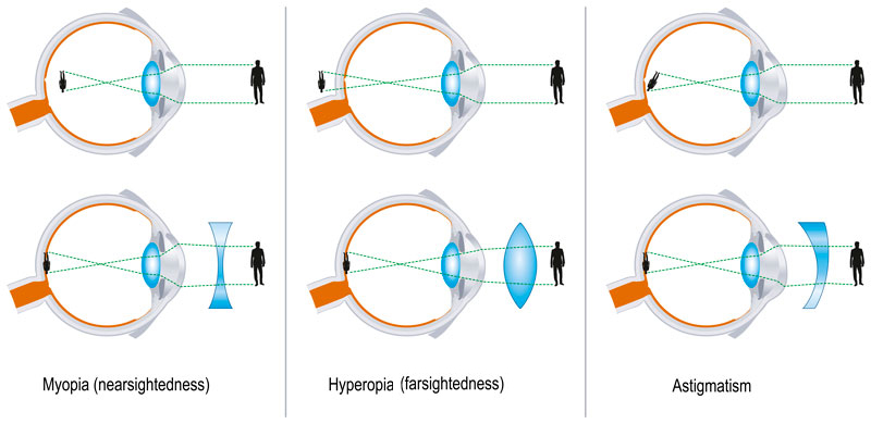 Myopia astigmatism lasik. Orthokeratologie pentru sportivi - Sănătate -
