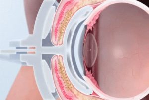 Dry Eye Treatment diagram