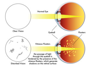 eye floaters - diagram