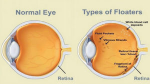 types of floaters