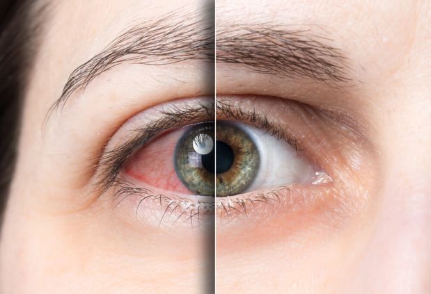 Dry Eye Syndrome Comparison